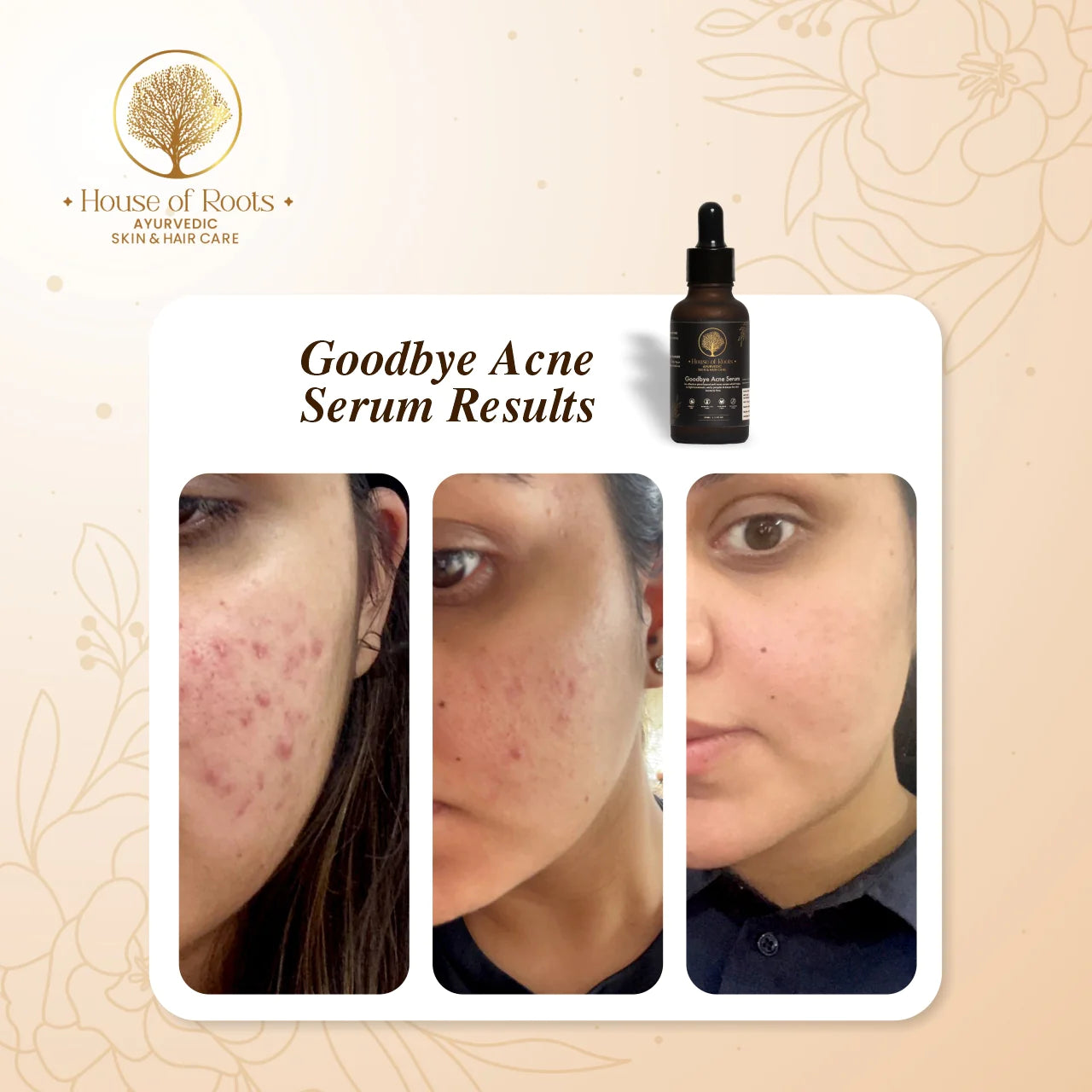 Goodbye Acne Serum
