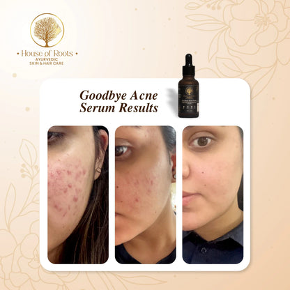 Goodbye Acne Serum